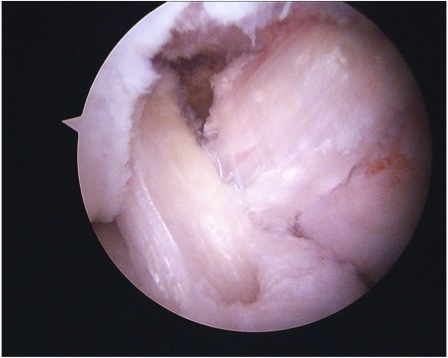 ACL PCL reconstruction